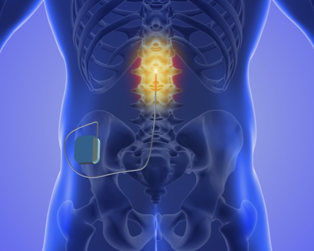 minimally invasive spine